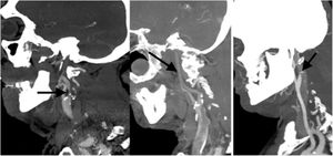 Angio-TC de TSA, MPR sagital. Izquierda: estenosis significativa en el origen de la ACI izquierda secundaria a placa de ateroma mixta (fibrolipídica y calcificada) con oclusión por trombo en M1 izquierda (no visualizado en esta imagen). Centro: dilución distal progresiva de la columna de contraste como signo indirecto de oclusión en la carótida terminal por trombo. Derecha: afilamiento brusco con oclusión en la región distal del bulbo carotídeo con imagen del pico de pájaro como signo de disección intimal.