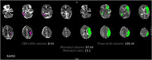 TC de perfusión cerebral con contraste por vía intravenosa. Paciente varón de 78 años con un déficit completo de la arteria cerebral media izquierda de 2h de evolución. En esta imagen podemos ver el procesamiento automático del software RAPID, donde se observa en rosa el CBF<30% en este caso de 8ml (tejido cerebral no recuperable, el core) y en verde el Tmáx> 6 s (tejido cerebral afectado). El volumen de mismatch nos da una idea del tejido cerebral recuperable y la mismatch ratio nos muestra la relación entre el tejido cerebral en riesgo y el infarto establecido, en este caso de 13,1, que estaría muy por encima del parámetro de los criterios DEFUSE 3 (mayor de 1,8), por lo que estaría indicada la realización de trombectomía mecánica.