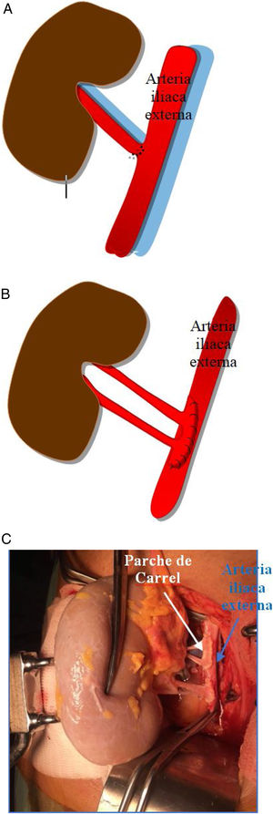 A) Sutura clásica lateroterminal. B) Esquema de parche de Carrel. C) Correlación in vivo del parche de Carrel.