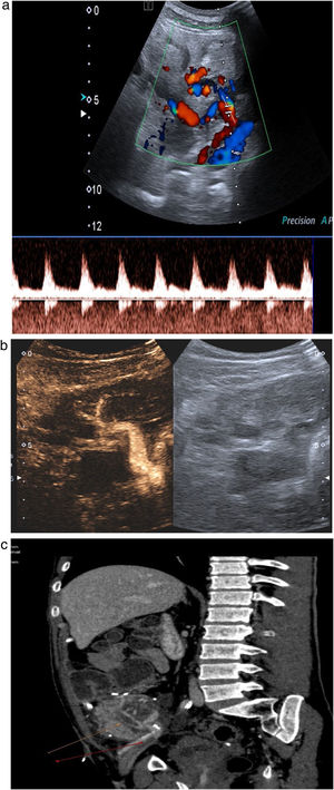 Trombosis venosa. A) La ecografía espectral del trasplante de páncreas revela la inversión del flujo diastólico en una arteria intrapancreática. No se pudieron identificar formas de onda venosa durante todo el trasplante. B) Trombosis venosa parcial con CEUS: solo se visualizan la vena mesentérica, pero sin porta, y la vena esplénica. C) Confirmación con TC: las flechas señalan trombosis venosa parcial.