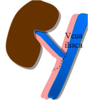 Sutura venosa término-lateral.