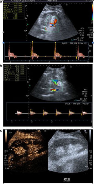 A) Curvas de sístole picuda y aumento del IR en paciente con trombosis de arteria renal. B) Curvas de baja velocidad y bajo IR a nivel de la arteria hiliar inmediatamente distal al trombo. C) CEUS. Ausencia de realce corticomedular en el paciente anterior.