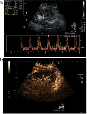 A) Engrosamiento cortical con pérdida de la diferenciación corticomedular. El estudio pulsado pone de manifiesto flujo arterial en vaivén. B) CEUS. Ausencia de realce corticomedular en el paciente anterior.