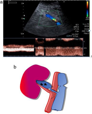A) Doppler pulsado con aumento de la velocidad en punto de aliasing o estenosis de la vena del injerto. B) Esquema que muestra la zona de estenosis.