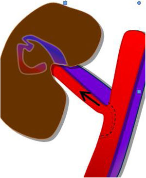 Fístula arterio-venosa.