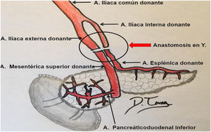 Diagrama del injerto en Y utilizado para la anastomosis arterial entre los vasos pancreáticos del donante y del receptor. Cortesía y con permiso de D. Tovar, HUGTIP.