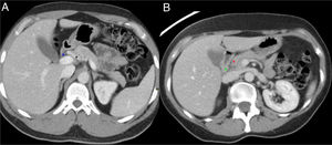 Anatomía normal del surco pancreaticoduodenal (PD). Cortes axiales del abdomen tras administración de contraste intravenoso en fase portal (A y B). Surco PD: espacio comprendido entre el colédoco (asterisco azul, A), la arteria hepática común (asterisco negro, A), la cabeza del páncreas (asterisco rojo, B) y la segunda porción duodenal (asterisco verde, B).
