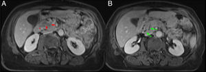 Mismo paciente de la Figura 9. Cortes axiales del abdomen en secuencia T1 FS poscontraste (VIBE). A y B) Masa hipointensa en cabeza pancreática respecto al resto del páncreas con ocupación del surco pancreaticoduodenal (flecha y asterisco rojos, A) y dilatación de vía biliar extrahepática y del CP (flechas verdes, B). El diagnóstico final fue de adenocarcinoma de páncreas.