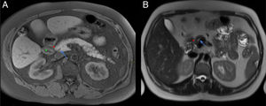 Anatomía normal del surco pancreaticoduodenal (PD). Cortes axiales del abdomen en secuencia T1 FS (A) y T2 (B). Surco PD: espacio comprendido entre la cabeza del páncreas (asterisco rojo, A y B), la segunda porción duodenal (asterisco verde, A) y el colédoco (flecha azul, A y B).