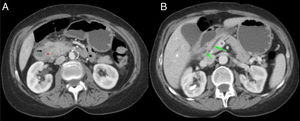 Paciente de 54 años ingresada por episodio de pancreatitis aguda. Cortes axiales del abdomen con contraste intravenoso en fase portal. A) Aumento de tamaño de la cabeza pancreática con borramiento del surco pancreaticoduodenal (asterisco rojo). B) Ectasia del conducto pancreático principal y colédoco distal (flecha verde) con defecto de repleción en la vena porta en relación con trombosis portal (flecha negra). Hallazgos en probable relación con pancreatitis del surco.