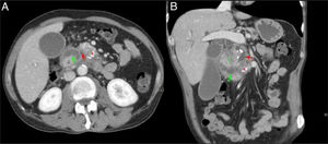 Varón de 60 años con síndrome constitucional. Corte axial (A) y coronal (B) del abdomen con contraste intravenoso en fase portal. Dilatación del conducto pancreático principal (flecha roja, A y B) y presencia de calcificaciones en la cabeza-cuerpo del páncreas (asterisco rojo, A y B), en relación con pancreatitis crónica. Ocupación del surco pancreaticoduodenal (asterisco verde, B) y engrosamiento mural duodenal con lesiones quísticas en su interior (flecha verde, A y B). Hallazgos compatibles con pancreatitis del surco.