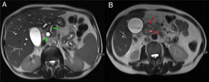 Mismo caso que la figura anterior. Cortes axiales del abdomen en secuencias T2. A) Dilatación de la vía biliar intra- y extrahepática y del conducto pancreático principal en cuerpo y cola del páncreas, con afilamiento del conducto pancreático principal en la cabeza pancreática (flechas verdes). B) Lesiones hiperintensas en la pared medial del duodeno que corresponden con lesiones quísticas (flechas rojas) con borramiento del surco pancreaticoduodenal (asterisco rojo).