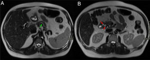Varón de 48 años con historia de alcoholismo y pancreatitis aguda de repetición. Cortes axiales del abdomen en secuencias T2. A) Dilatación del conducto pancreático principal (flecha verde). B) Borramiento de los planos grasos del surco pancreaticoduodenal y pequeñas imágenes de aspecto quístico en pared duodenal (flechas rojas). Estos hallazgos, dado el antecedente del paciente, son compatibles con pancreatitis del surco.