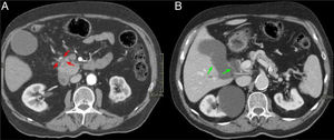 Varón de 74 años con ictericia y síndrome constitucional. Cortes axiales del abdomen con contraste intravenoso en fase arterial (A) y portal (B). Pequeña masa hipovascular en la cabeza - proceso uncinado del páncreas (flechas rojas, A) que envuelve a la arteria gastroduodenal y condiciona una dilatación de la vía biliar extrahepática e hidrops vesicular (flechas verdes, B).