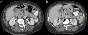 Mujer de 65 años con diarrea crónica. Cortes axiales del abdomen tras administración de CIV en fase portal (A y B). Tenue hipodensidad en la cabeza-proceso uncinado del páncreas que contacta con la vena mesentérica superior (flechas rojas, A). Dilatación de la vía biliar extrahepática y del CP (signo del doble conducto) (flechas verdes, B) y borramiento del surco pancreaticoduodenal (asterisco rojo, A). Hallazgos sugestivos de neoplasia de páncreas.