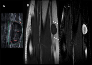 Schwannoma del nervio radial. A) Imagen de ecografía Doppler microvascular de una niña de 11 años con un nódulo palpable en la superficie externa del antebrazo. Se observa una lesión ovalada hipoecoica de bordes bien definidos con un centro ligeramente hiperecogénico, que presenta flujo interno. B) Imagen de RM potenciada en T1 en el plano coronal. Se observa crecimiento excéntrico de la lesión desde el nervio radial (flechas). C) Imagen de RM potenciada T2 con supresión de la grasa en el plano coronal. La periferia de la lesión es hiperintensa y la región central hipointensa (signo de la «diana»).