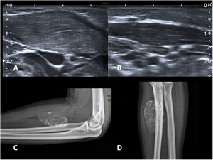 A y B) Fibromatosis colli. Lactante de 2 meses con un nódulo palpable laterocervical derecho y tortícolis. Imágenes longitudinales de ambos músculos esternocleidomastoideos (ECM) en una ecografía en escala de grises. Se observa un engrosamiento fusiforme del ECM del lado afectado (A) frente al normal (B). C y D) Miositis osificante. Radiografías AP y lateral del antebrazo de un adolescente de 15 años con una masa dura palpable y antecedente traumático. Se observa el aspecto típico con calcificación periférica. No es necesaria ninguna prueba de imagen más.