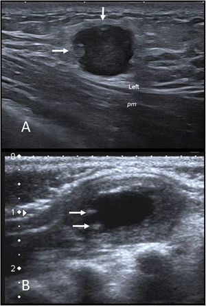 A) Fascitis nodular. Imagen de ecografía en escala de grises de un nódulo infraclavicular izquierdo en una niña de 14 años. Se observa un nódulo hipoecogénico con borde lobulado bien definido que impronta sobre el músculo pectoral mayor (pm). Muestra algunas imágenes nodulares hiperecogénicas periféricas (flechas) y aumento de la ecogenicidad de la grasa subcutánea circundante. B) Miofibroma infantil. Ecografía en escala de grises de un nódulo palpable en la región escapular izquierda de un lactante de 2 meses. Se observa un nódulo ovalado de bordes bien definidos en el músculo trapecio. La periferia es isoecogénica con el músculo y el centro anecoico con pequeñas calcificaciones en su periferia (flechas).