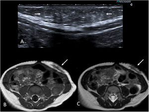 Niño de 9 meses con un tumor desmoide en la pared abdominal anterior. Antecedente familiar de primer grado con poliposis colónica. A) Imagen de ecografía en escala de grises donde se observa una lesión ligeramente hiperecogénica y con bordes mal definidos en la grasa subcutánea (flechas). B y C) Imágenes de RM potenciadas en T1 y T2 respectivamente, en el plano axial. Se identifica la lesión con bordes mal definidos en el tejido celular subcutáneo de la pared abdominal anterior (flechas). Destaca su baja intensidad de señal en T2 debido a su naturaleza fibrosa.