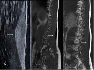 Niño de 9 años con fibroma de Gardner en la musculatura erectora de la columna. A) Imagen de ecografía en escala de grises en el plano sagital, donde se observa una lesión fusiforme marcadamente hiperecogénica en la fascia muscular (flecha). B y C) Imágenes de RM del mismo paciente potenciadas en T1 y T2, respectivamente. Nótese la baja intensidad de señal de la lesión en T1 y T2 debido a su naturaleza fibrosa (flechas).