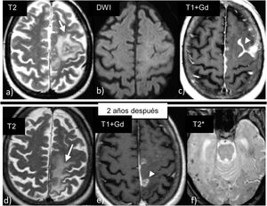 Angiopatía amiloide cerebral asociada a inflamación en un paciente varón de 72 años con crisis. Las imágenes de la fila superior muestran hiperintensidad de señal en T2 (a) en la sustancia blanca izquierda sin restricción en difusión (b) y que se acompaña además de una captación leptomeníngea (c). Ante la sospecha de una angiopatía amiloide inflamatoria, el paciente fue tratado con esteroides con muy buena evolución. Presentó un nuevo brote dos años después, recidivando en una localización diferente (d y e). En las secuencias eco de gradiente (f), presentaba además las múltiples microhemorragias corticales características de la angiopatía amiloide.