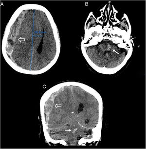 Imágenes de TC craneal sin contraste intravenoso, cortes axiales (A y B) y coronal (C). Se identifica una colección hemorrágica extraaxial derecha de densidad mixta con morfología en semiluna en relación con un hematoma subdural agudo hemisférico derecho, de espesor máximo de 2cm (flecha hueca). Dicha colección ejerce marcados efectos expansivos condicionando una herniación subfalcina con desviación de la línea media hacia la izquierda de aproximadamente 25mm y colapso casi completo del sistema ventricular derecho, así como borramiento de las cisternas basales en relación con herniación transtentorial descendente, que asocia focos centrales hiperdensos en la protuberancia y el mesencéfalo, sugerentes de hemorragia de Duret (flecha fina), que se extiende al acueducto de Silvio.