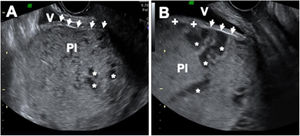 Diagnóstico ecográfico de placenta previa con acretismo. Se objetiva placenta previa insertada en la cara anterior del segmento inferior uterino (la localización más frecuente). El miometrio está muy adelgazado, llegando a ser indetectable. La «línea vesical», que marca la separación entre las serosas uterina y vesical, aparece como una línea ecogénica (flechas), que llega a desaparecer en algún punto (+). Este signo debe hacernos sospechar una placenta percreta Pl: placenta; V: vejiga; *: lagunas vasculares.