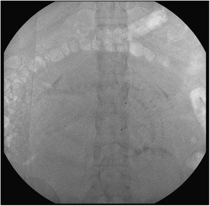 Adquisición de escopia previa a la cesárea para comprobar el correcto posicionamiento del balón en la aorta abdominal infrarrenal. Se identifican 2marcas radioopacas que nos señalan los límites del balón.