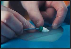 Introductor y marca negra del balón. El balón debe introducirse hasta la marca negra, lo que nos asegura con un 95% de probabilidad su situación en la aorta infrarrenal.