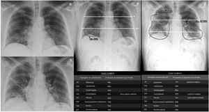 Paciente con febrícula, mialgia, malestar general y una semana de evolución con RT-PCR positiva para SARS-CoV-2 y neumonía visible en la radiografía torácica (RXT) en proyección posteroanterior, obtenida en días consecutivos (a y b) y detectada con la herramienta Thoracic Care Suite de GE Healthcare (que incorpora Lunit Insight CXR) (c y d). Los pulmones se dividen en 6campos dibujando una línea manual que atraviesa el margen inferior del cayado aórtico (*) y otra (**), que divide el pulmón por debajo de la primera en 2partes de tamaño superior-inferior lo más similar posible. El área de consolidación detectada por la herramienta, que afecta 2campos pulmonares en la primera RXT, está rodeada con un círculo en c. En el estudio de RXT realizado el día siguiente, la herramienta detecta un aumento de la extensión de las consolidaciones, con atelectasia entre ellas (d). La extensión de la afectación progresó de 2 a 6 campos pulmonares, es decir, 4 campos pulmonares en un día. El paciente precisó ventilación mecánica. Los datos que se presentan en las tablas siguientes, a saber, probabilidad (%) de cada resultado, ubicación de los resultados, resultados distintos a «consolidaciones», «atelectasia» y «nódulos» y la «puntuación de detección de tuberculosis» no se tuvieron en cuenta para este estudio.