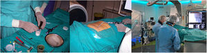 Técnica de la femoroplastia. Sedación y anestesia local. Agujas (10-13 G) guiadas por TC o fluoroscopia. Estricta asepsia. En ocasiones es necesario martillo o taladro para perforar la cortical, si no es posible hacerlo «a mano libre». Acceso antero-lateral (para evitar el tendón del recto femoral). Tras la mezcla de cemento PMMA+tántalo (radioopaco)+antibiótico (gentamicina 2 g), hay 3 min aproximadamente antes de que consolide. Control mediante imagen para descartar fugas y progresión proximal.