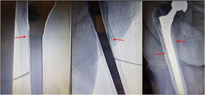 Técnica de la femoroplastia. Control mediante imagen. Paciente de 81 años. La imagen fluoroscópica muestra la ubicación perivástago protésico de la aguja de vertebroplastia, con el bisel encarado hacia la zona de interés. Se confirma la progresión lineal perivástago del cemento durante la inyección del mismo (flechas) en diferentes proyecciones.
