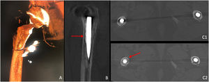 Técnica de la femoroplastia. Control mediante imagen. Paciente de 80 años. La imagen 3D tras adquisición rotacional (axiom artis; vascular) (A) muestra la ubicación perivástago protésico de la aguja de vertebroplastia. Se confirma la ubicación perivástago del cemento (flecha; B). Imágenes TC axiales comparativas basal (imagen C1) y tras la femoroplastia (imagen C2), que muestra que el cemento se dispone de forma anular alrededor del vástago (flecha).