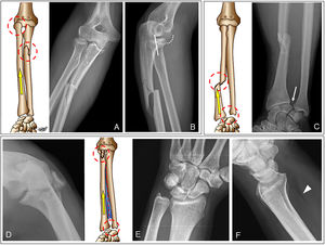 A y B) Fractura-luxación de Monteggia. Fractura conminuta del tercio proximal de la diáfisis del cúbito y luxación posterolateral de la cabeza radial. Los hallazgos de la luxación son sutiles: la línea punteada indica la superficie articular del cóndilo; la línea radiocondílea (línea blanca sólida) es la línea que pasa por el centro del cuello del radio y debe intersectar el centro del cóndilo en cualquier proyección. En ambas proyecciones, anteroposterior (A) y lateral (B), la línea radiocondílea no intersecta el centro del cóndilo, siendo más evidente en la proyección lateral. C) Fractura-luxación de Galeazzi. Fractura del tercio distal de la diáfisis del radio y luxación de la articulación radiocubital distal (flecha blanca). D-F) Lesión de Essex-Lopresti. Fractura desplazada de la cabeza del radio. No se observan anomalías aparentes en la articulación radiocubital distal (E), pero la radiografía lateral (F) muestra un desplazamiento de la línea grasa del pronador (punta de flecha) como signo de lesión de partes blandas. La articulación era dolorosa y, pese a que fue fijada quirúrgicamente, el paciente desarrolló una inestabilidad vertical del antebrazo.