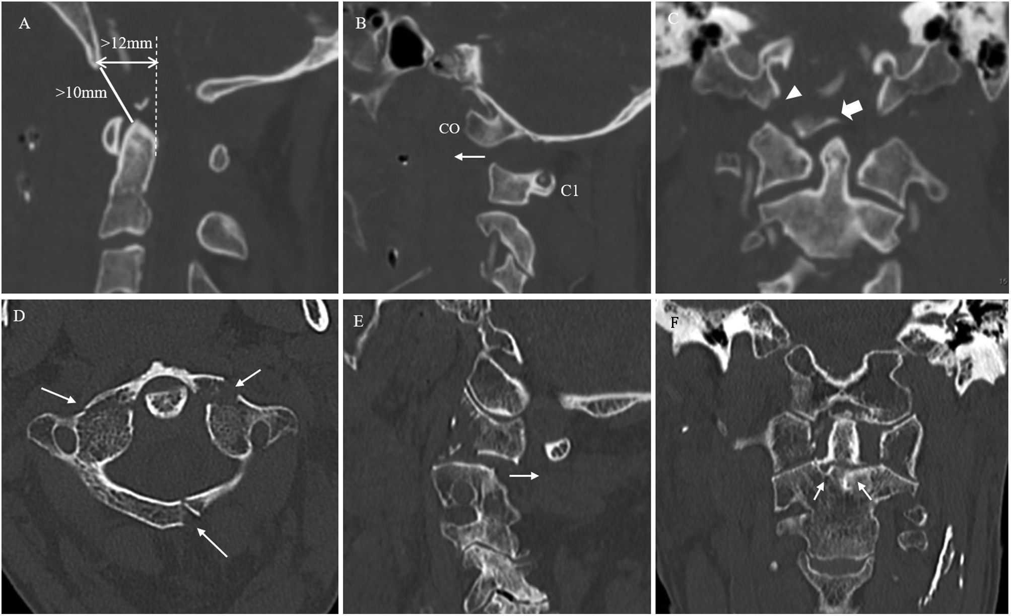Traumatismo De La Columna Vertebral Cervical Radiolog a traumatismo-de-la-columna-vertebral-cervical-radiolog-a