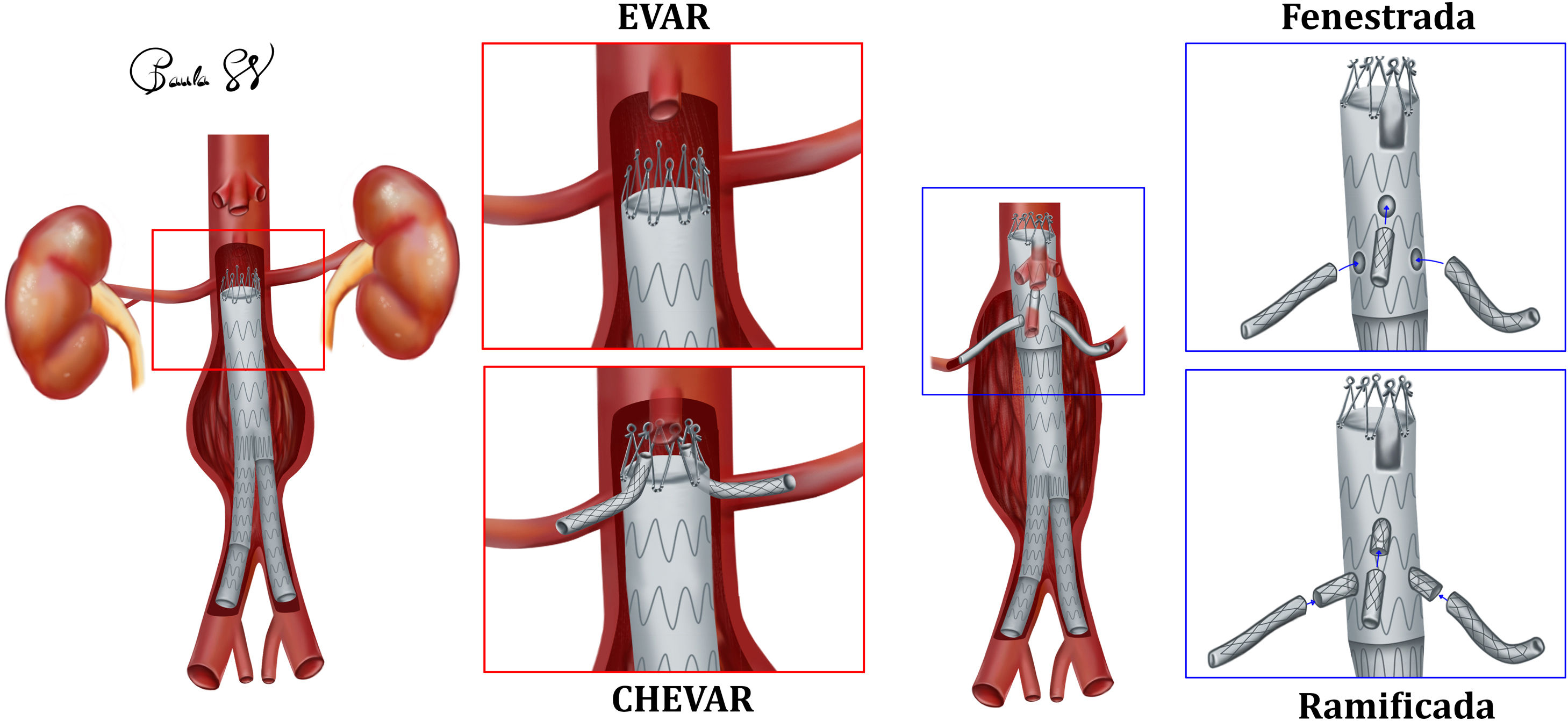 Aneurisma de aorta abdominal roto, ¿qué necesitan el radiólogo ...