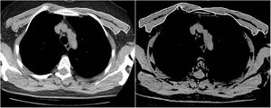 Imagen de tomografía computarizada torácica axial justo por encima del cayado aórtico. Ambos músculos pectorales, mayor y menor, se representaron manualmente, y la medición del área se realizó automáticamente en un intervalo de atenuación de entre −50 y 90 unidades de Hounsfield.