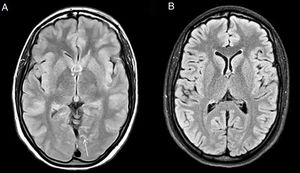 Cefalea de HaNDL. Imagen FLAIR axial (A) en la que se observa una tenue hiperintensidad en los surcos paramedianos occipitales (flechas). En la RM de control SPIR FLAIR (B) un mes más tarde se demostró la desaparición de estos hallazgos.