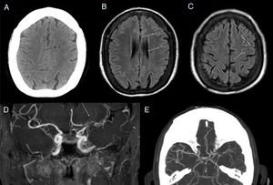 Enfermedad de moyamoya. Mujer de 60 años con estenosis de vasos principales intracraneales, con patrón de moyamoya. En la TC craneal sin CIV (A) se observan pequeñas lesiones isquémicas (flecha negra) de cronología indeterminada en territorio frontera subcortical. Las imágenes FLAIR (B y C) muestran una discreta hiperintensidad de señal lineal en los surcos de la convexidad adyacentes (flechas blancas), reflejando el aumento de la colateralidad pial. La angio-RM (D) confirma la estenosis del segmento supraclinoideo de la ACI y segmento M1 de la ACM (flecha blanca) izquierdas. En la angio-TC (E) también se muestra la proliferación de una red vascular profunda rodeando los segmentos estenosados (flecha blanca).