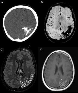 Síndrome de Sturge-Weber. Extensa calcificación giral y leptomeníngea (flecha negra) en el lóbulo parietal izquierdo, visualizados en la TC de cráneo sin CIV (A). RM de control 5 años después (B-D): en la secuencia T2* FFE (B) se observa el artefacto de susceptibilidad (*) provocado por las calcificaciones; en la secuencia FLAIR (C) y T1 tras administración de CIV, atrofia cortical focal, hiperseñal del ESA y realce leptomeníngeo (flecha blanca en D) en los surcos de la convexidad parietal izquierda, reflejando la malformación venosa leptomeníngea típica de esta enfermedad. También se observa hiperostosis frontal y una sutil hiperintensidad cutánea que corresponde a la mancha en vino de oporto en el lado izquierdo (flecha blanca en C). Cortesía del Dr. Lancharro Zapata y Dra. Aguado del Hoyo.
