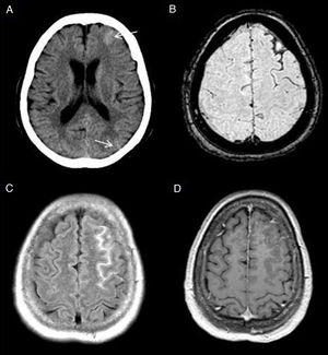 Hemorragia subaracnoidea (HSA). En la imagen TC existe una tenue hiperdensidad en surcos frontal superior y parietooccipital izquierdos (flechas) en relación con HSA no traumática (A). El contenido hemático de los surcos frontal superior y prerrolándico produce una hipointensidad por susceptibilidad en la secuencia T2*FFE (B) y una hiperintensidad en la secuencia FLAIR (C). No presenta realce en la secuencia T1 con CIV (D). No se demostraron aneurismas o anomalías vasculares en la angiografía de sustracción digital.