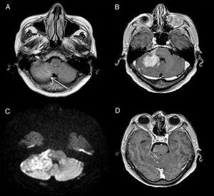 Linfomatosis leptomeníngea secundaria por contigüidad. En la imagen FLAIR (A) se identifica una hiperintensidad en los surcos entre las folias cerebelosas (flecha) debido a una infiltración leptomeníngea por contigüidad a una masa linfomatosa cerebelosa que muestra un intenso realce en la secuencia T1 con gadolinio (B) y una restricción de la difusión (C). La afectación de la leptomeninge presenta captación en la T1 secuencia tras la administración de Gd (D).