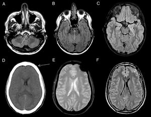 Artefacto por pulsatilidad del LCR. En las imágenes axiales FLAIR se observa una hiperintensidad de señal de LCR no patológica en cisternas peribulbar (A), prepontina (B) y supraselar(C). Artefacto por susceptibilidad magnética. La imagen de TC (D) muestra un cuerpo extraño milimétrico de densidad metálica en el tejido celular subcutáneo (flecha) que ocasiona un artefacto por susceptibilidad magnética en secuencias T2* eco de gradiente (E) y una hiperintensidad de señal lineal por artefacto en FLAIR (F) en el espacio subaracnoideo subyacente (flecha).
