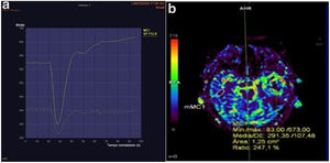 A)Ejemplo de curva de perfusión medida en uno de los pacientes. B)En esta imagen se puede apreciar, mediante escala de colores, el volumen sanguíneo que llega a cada parte. Mediante la ROI (región de interés) elíptica se ha seleccionado la zona en la que se pretende medir la perfusión y se ha espejado de forma que se mida exactamente la misma zona del cerebro contralateral. Se comprueba que la perfusión (rVSC) es 2,47 mayor en el lado con el tumor.