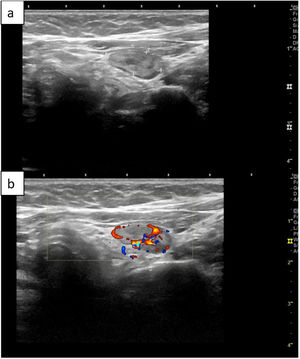 Adenoma paratiroideo inferior izquierdo observado mediante ecografía. Ecografía en modo B (a) y Doppler (b), en la que puede verse un ejemplo típico de adenoma paratiroideo como una masa bien definida, hipoecoica e hipervascular en modo Doppler.