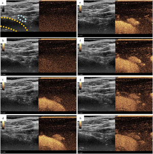 Adenoma paratiroideo inferior derecho observado mediante ecografía con contraste: a) Ecografía en modo B que muestra una lesión hipoecoica de 5mm (rodeada en azul claro) adyacente al tronco braquiocefálico derecho (rodeado en amarillo), junto con una imagen que muestra un índice mecánico inferior, y que permite la visualización del medio de contraste, ambas obtenidas antes de su administración. b-h) Representación del estudio dinámico a los 2, 7, 8, 11, 20, 47 y 57s, respectivamente tras la administración del contraste ecográfico. En este estudio dinámico, podemos observar como la lesión sospechosa presenta un realce intenso y precoz con lavado tardío, hallazgos que sugieren un adenoma paratiroideo.