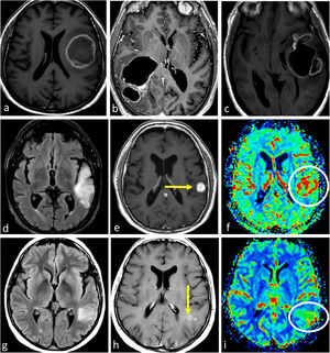 Tres presentaciones típicas diferentes del glioblastoma IDH-wildtype en pacientes de entre 60 y 70 años. a-c) características paradigmáticas en imágenes axiales T1w poscontraste de tres pacientes diferentes, con márgenes irregulares, realce en anillo y necrosis extensa. d-f) FLAIR axial, T1w poscontraste y mapas de color del CBV de DSC-PWI. Extensa lesión infiltrante temporal izquierda en FLAIR (d) con realce nodular sólido asociado y sin necrosis (flecha en d), pero con CBV claramente elevado (círculo en f). g-i) FLAIR axial, T1w poscontraste y mapas de color de CBV de DSC-PWI. Lesión infiltrante temporal izquierda en FLAIR focal (g) con realce mínimo y ausencia de necrosis (flecha en h), pero con CBV claramente elevado (círculo en i). CBV: volumen sanguíneo cerebral; DSC-PWI: imagen de perfusión dinámica; IDH: gen isocitrato deshidrogenasa.