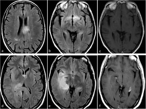 Posible presentación de glioblastoma IDH-wildtype con alteración molecular de TERT o EGFR. Dos pacientes, uno de 80 años (a-c) y otro de 55 años (d-f). En secuencias FLAIR axiales (a-b y d-e), hiperintensidades infiltrantes difusas y extensas que recuerdan un patrón de gliomatosis cerebral en glioblastomas con mutación del promotor TERT. Las imágenes T1w poscontraste (c y f) no muestran realce ni signos de necrosis. EGFR: receptor del factor de crecimiento epidérmico; IDH: gen isocitrato deshidrogenasa; TERT: transcriptasa inversa de la telomerasa.