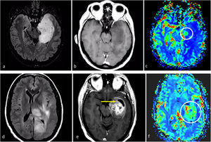 Dos casos de ejemplo en los que los resultados de la biopsia podrían corresponder a un grado histológico 2-3 para un tumor que en realidad sería de grado 4. a-c) Paciente de 57 años. FLAIR axial (a), T1w poscontraste (b) y mapas de color de CBV derivados de DSC-PWI (c). Extensa lesión infiltrante temporal medial izquierda hiperintensa en FLAIR (a), sin realce ni necrosis (b), y un sutil foco nodular de CBV claramente elevado (círculo en c). Es decir, con una biopsia que no captara los focos de CBV elevado se correría el riesgo de subestimar el grado este tumor astrocítico IDH-wildtype como grado 2-3 (NEC) en el estudio anatomopatológico. d-f) Paciente de 58 años. FLAIR axial (d), T1w poscontraste (e) y mapas de color de CBV derivados de DSC-PWI (f). Extensa lesión infiltrante temporal medial izquierda hiperintensa en FLAIR en (d), con un área más focal de realce prominente y necrosis (flecha en e), así como CBV elevado (círculo en f). Es decir, con una biopsia que no captara la necrosis o el componente de CBV elevado se correría el riesgo de subestimar el grado este tumor astrocítico IDH-wildtype como grado 2-3 (NEC) en el estudio anatomopatológico. Se trató a ambos pacientes como glioblastomas IDH-wildtype según la decisión consensuada de un comité de neurooncología. CBV: volumen sanguíneo cerebral; DSC-PWI: imagen de perfusión dinámica; IDH: gen isocitrato deshidrogenasa; NEC: not elsewhere classified.