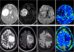 Dos pacientes diferentes con características de imagen típicas de astrocitoma IDH-mutado grado 2-3. Sujetos de 31 (a-d) y 34 (e-h) años. Axial T2w (a y e), FLAIR (b y f), DWI (c y g) y mapas de color de CBV derivados de DSC-PWI (d y h). Masas redondeadas, bien definidas e hiperintensas en T2w con la correspondiente hipointensidad en FLAIR, con un fino borde periférico de hiperintensidad: signo de mismatch T2/FLAIR. Sin restricción significativa de la difusión en DWI y CBV bajo en los mapas de color de CBV. CBV: volumen sanguíneo cerebral; DSC-PWI: imagen de perfusión dinámica; DWI: imagen potenciada en difusión; IDH: gen isocitrato deshidrogenasa.